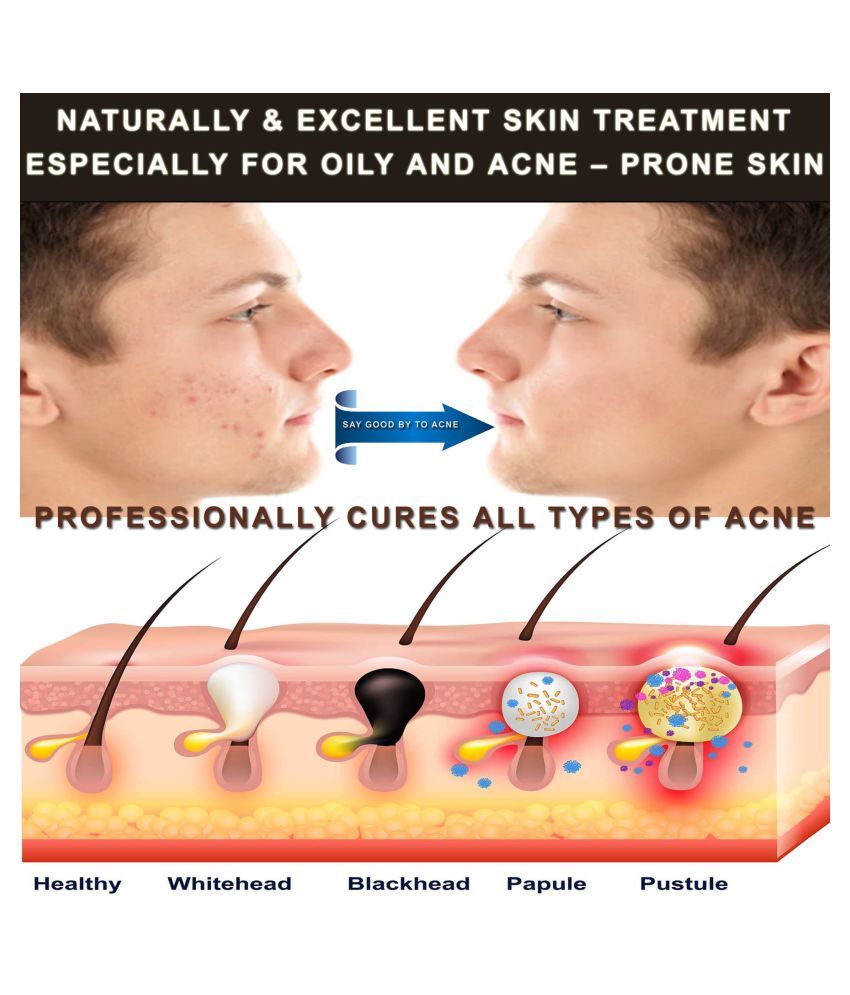 amueroz anti acne serum