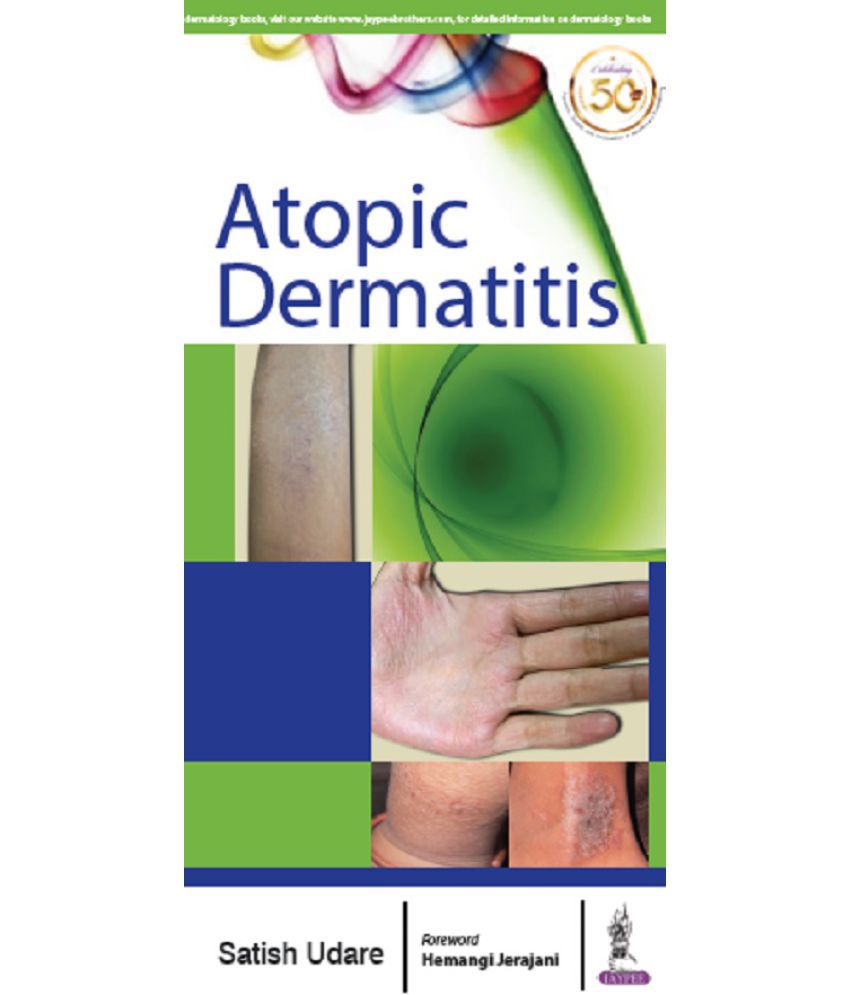 best cheap atopic dermatitis itch relief medication us
