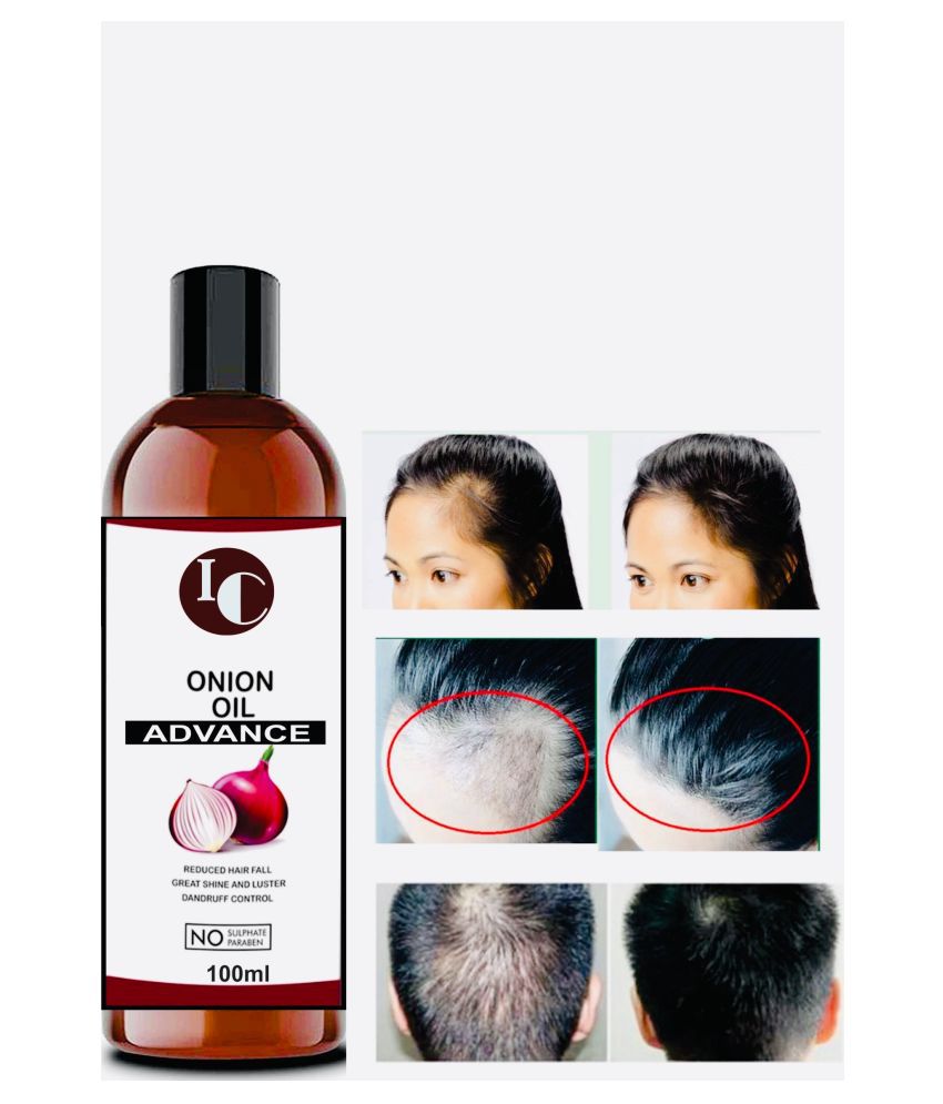 Buy Caleo Onion Hair Oil 200ml for Hair growth Control Dandruff with  Paraben Free Onion Oil Olive Oil Coconut Oil Almond Oil extracts Online  at Low Prices in India  Amazonin