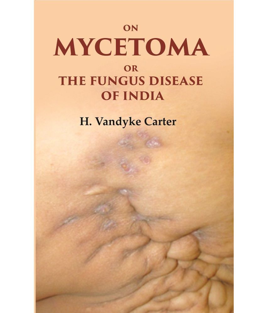     			On Mycetoma or the Fungus Disease of India